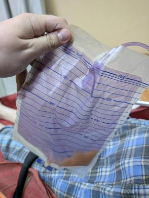 В Балаково медики спасли пациента с редким синдромом фиолетового мочеприемника